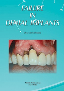 Failure in Dental Implants