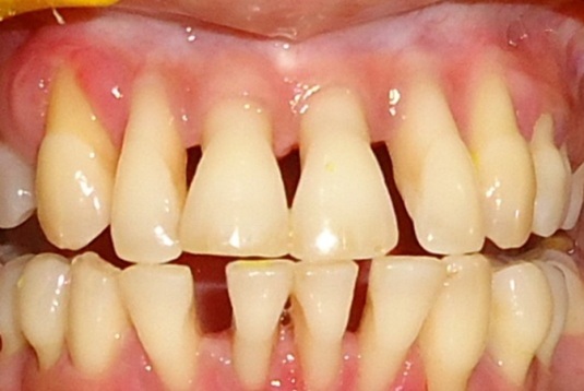 vejviser Suri klippe Turn up your smile by gingival masks - A prosthetic approach: Case report